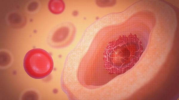 Comprendre les stades de l'hépatite C et le risque de cirrhose